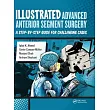 Illustrated Advanced Anterior Segment Surgery： A Step─By─Step Guide for Challenging Cases