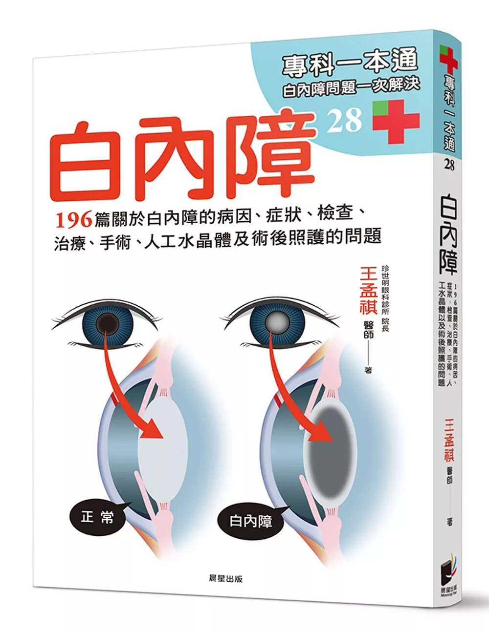 白內障：196篇關於白內障的病因、症狀、檢查、治療、手術、人工水晶體以及術後照護的問題