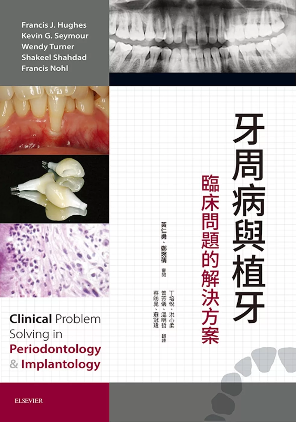 牙周病與植牙：臨床問題的解決方案