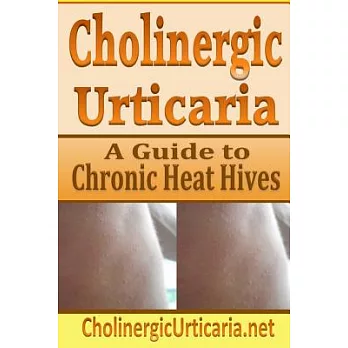 Cholinergic Urticaria: A Guide to Chronic Heat Hives