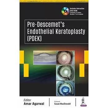 Pre-Descemet’s Endothelial Keratoplasty (PDEK)